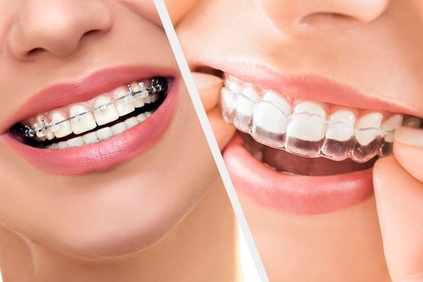 What's the difference between Clear Braces and Fixed Braces?
