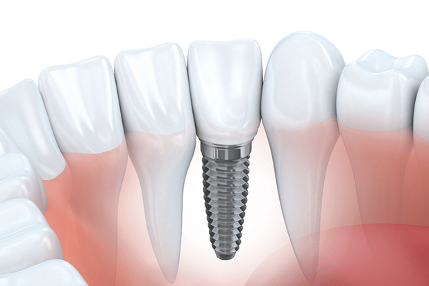 Take Care of Your Dental Implants
