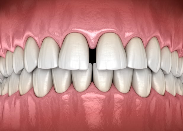 Best Dental Options for Gapped Teeth